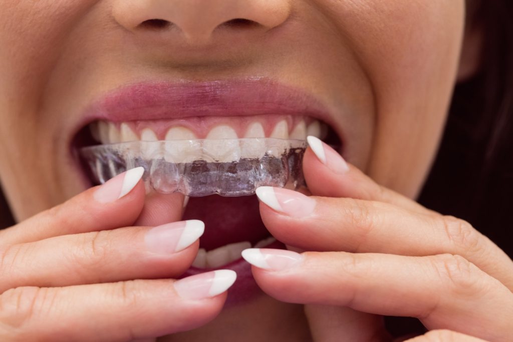 La ortodoncia invisible se convierte en la nueva moda dental