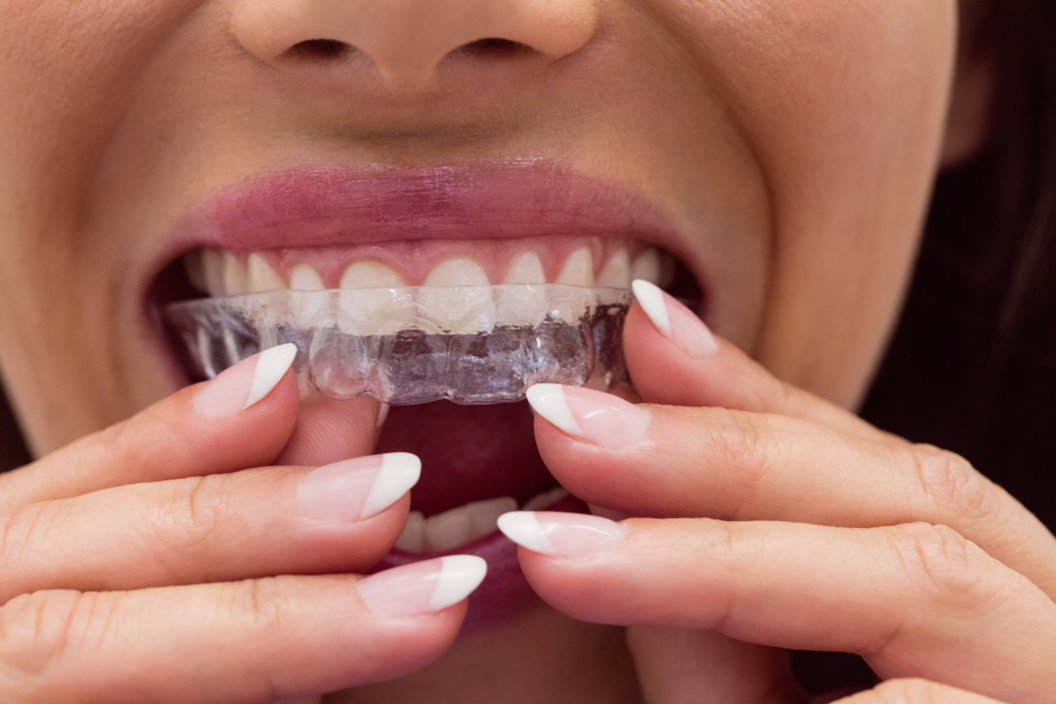La ortodoncia invisible se convierte en la nueva moda dental